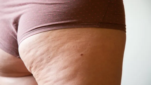 Cellulite