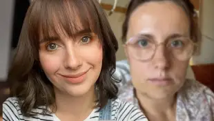 Anna Heiser zeigt verändertes Gesicht nacht OP