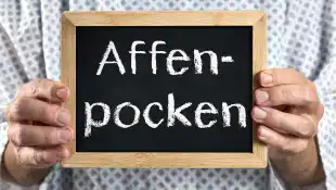 mpox virus affenpocken