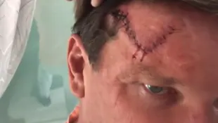 Steff Jerkel mit narbe krebs