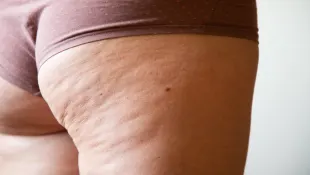 Cellulite