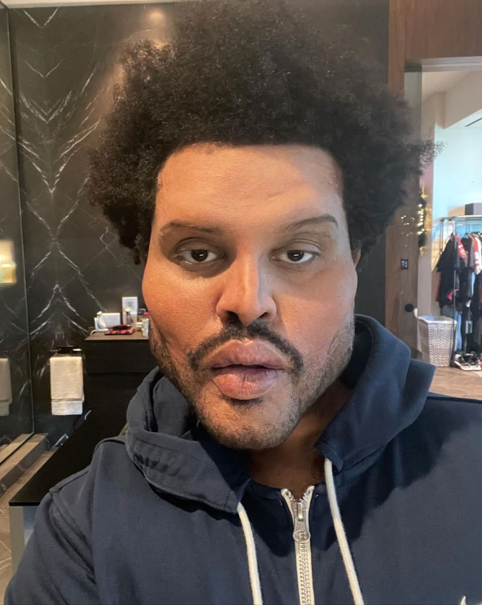 Was ist da passiert? The Weeknd schockt mit verzerrtem Gesicht