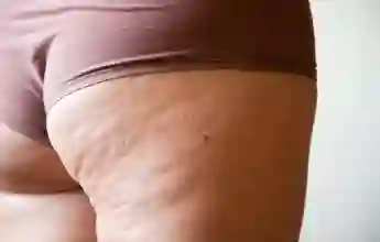 Cellulite