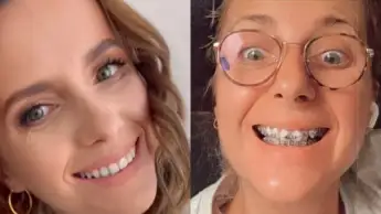 Anna Heiser trug lange eine Zahnspange