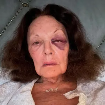 Diane von Fürstenberg hatte einen Unfall