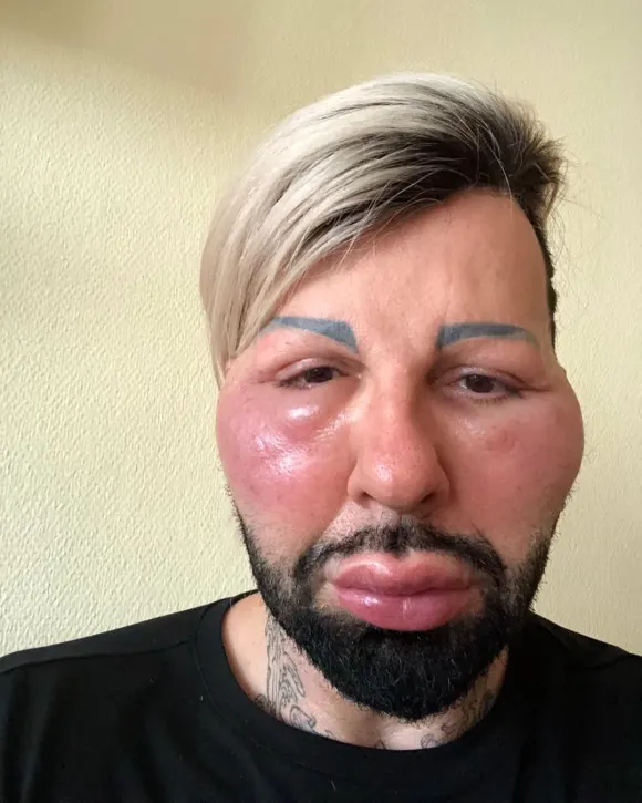 Harald Glööckler mit angeschwollenem Gesicht nach einer allergischen Reaktion
